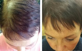 Before + After - Female Hair Loss