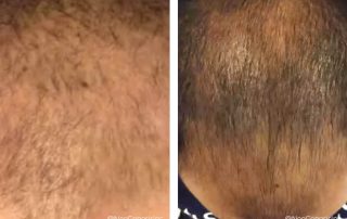 Before + After - Hair Loss