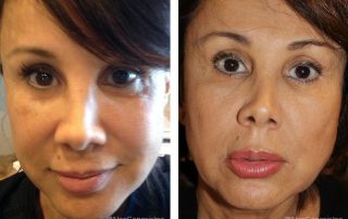 Before + After - Hyperpigmentation