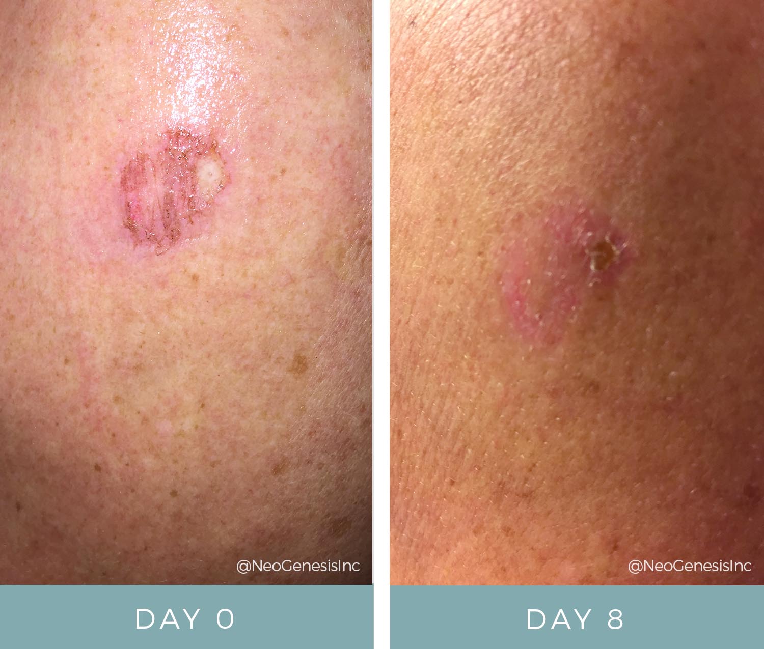 Before + After - Melanoma Surgery
