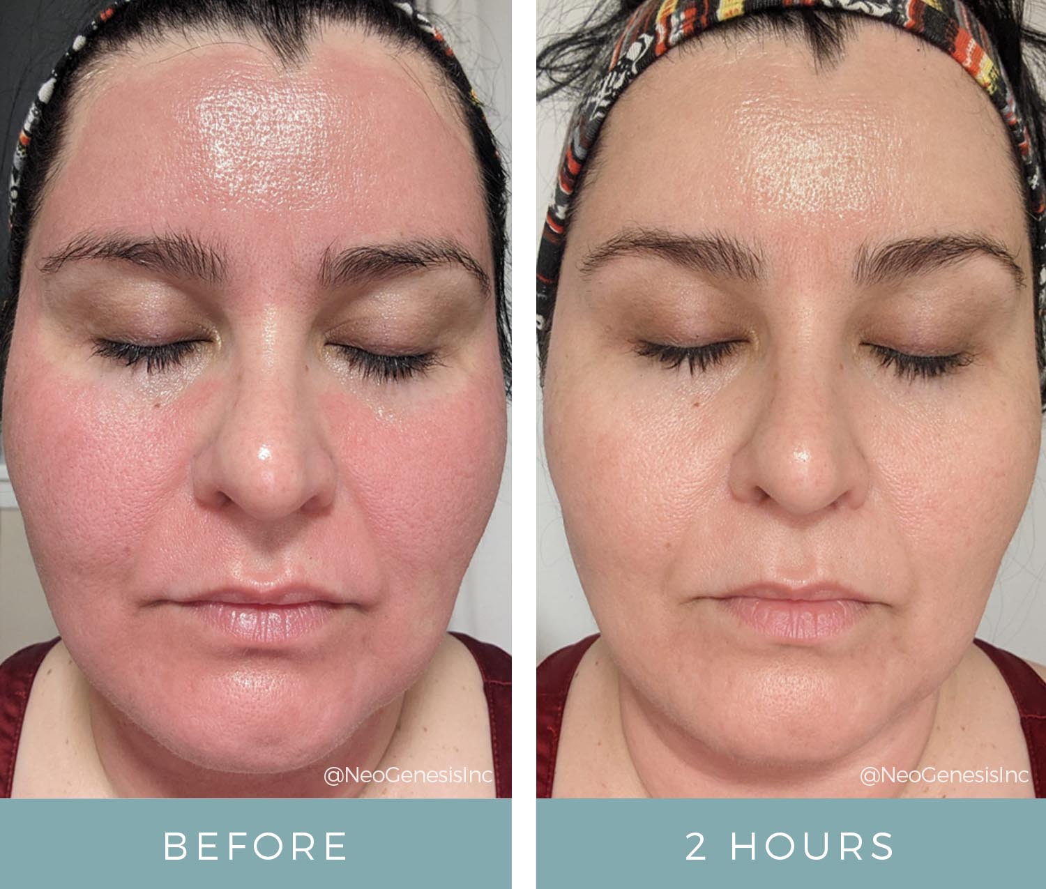 Before + After - Microneedling and Recovery serum