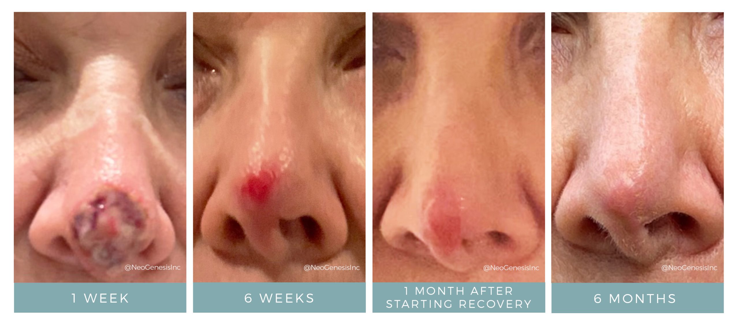 Before + After - Mohs Surgery