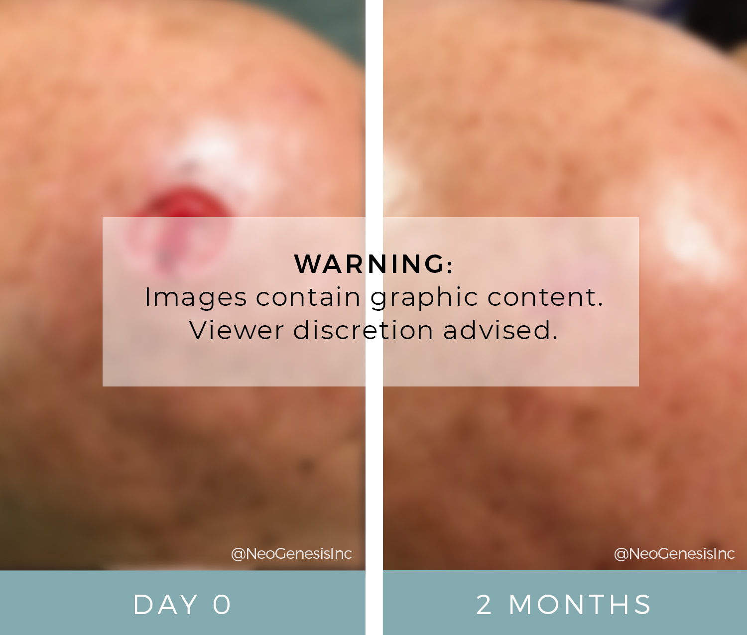 Before + After - Mohs Surgery for Squamous Cell Carcinoma