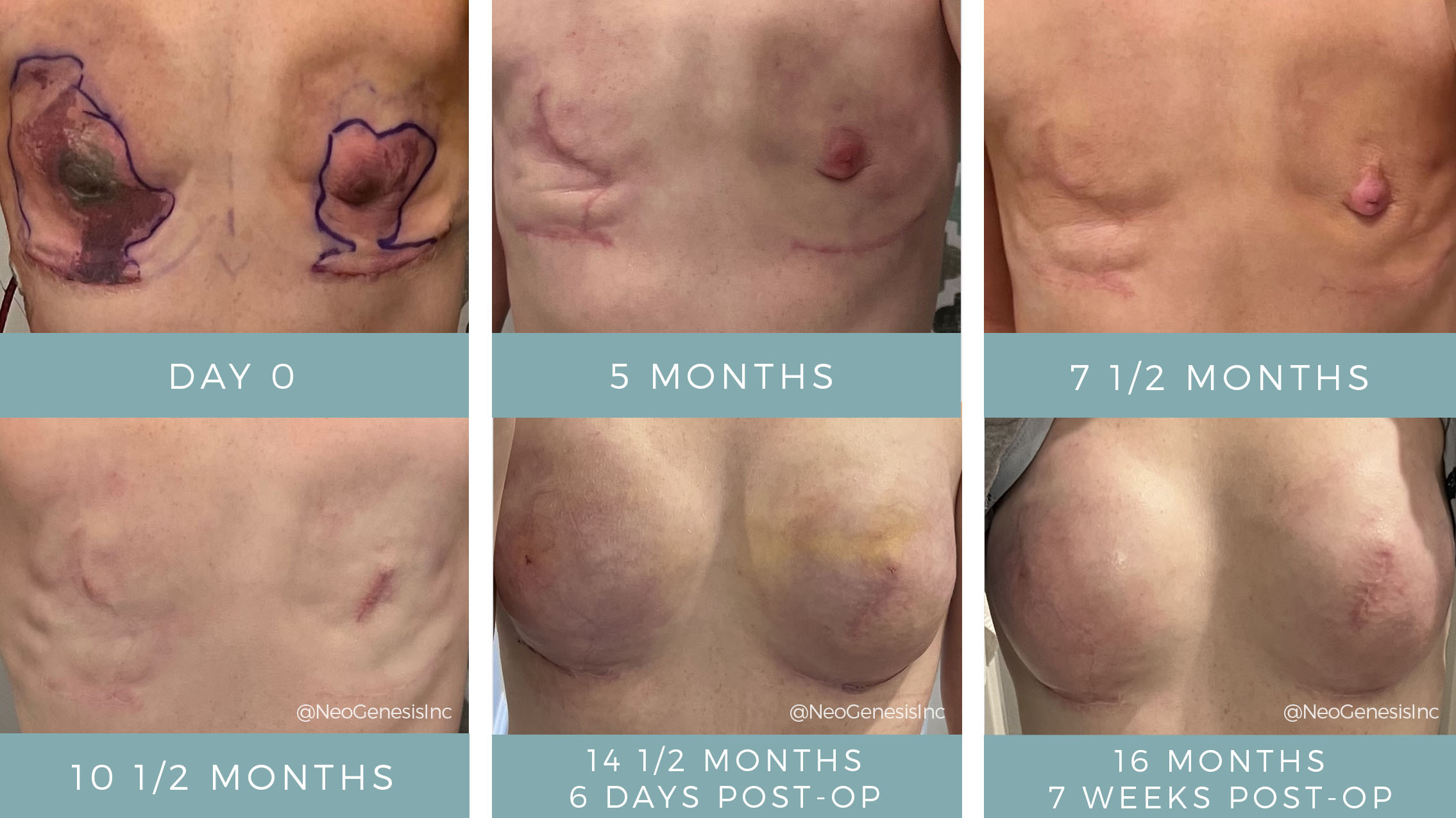 Before + After - Double Mastectomy + Necrosis