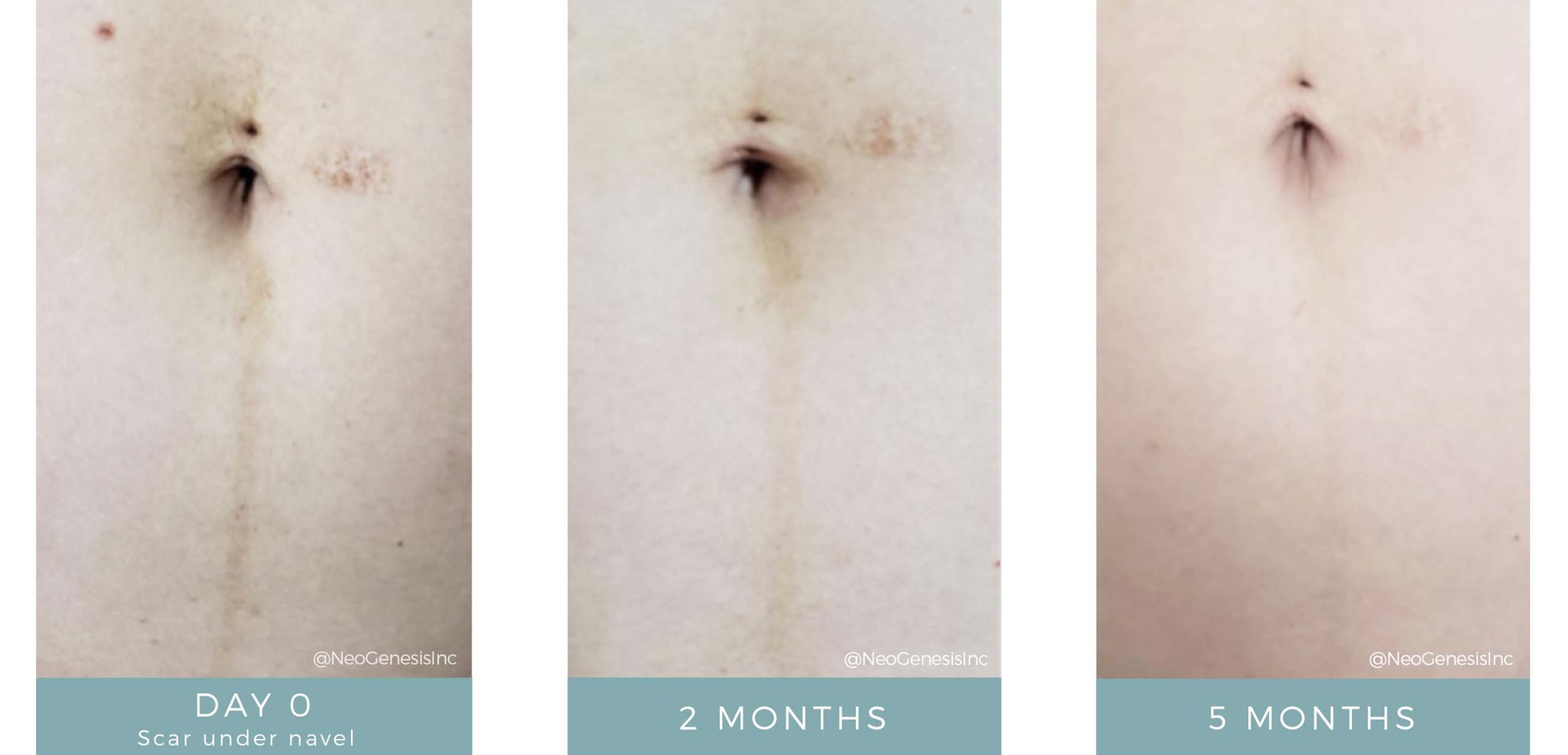 Before + After - Post Pregnancy Scarring