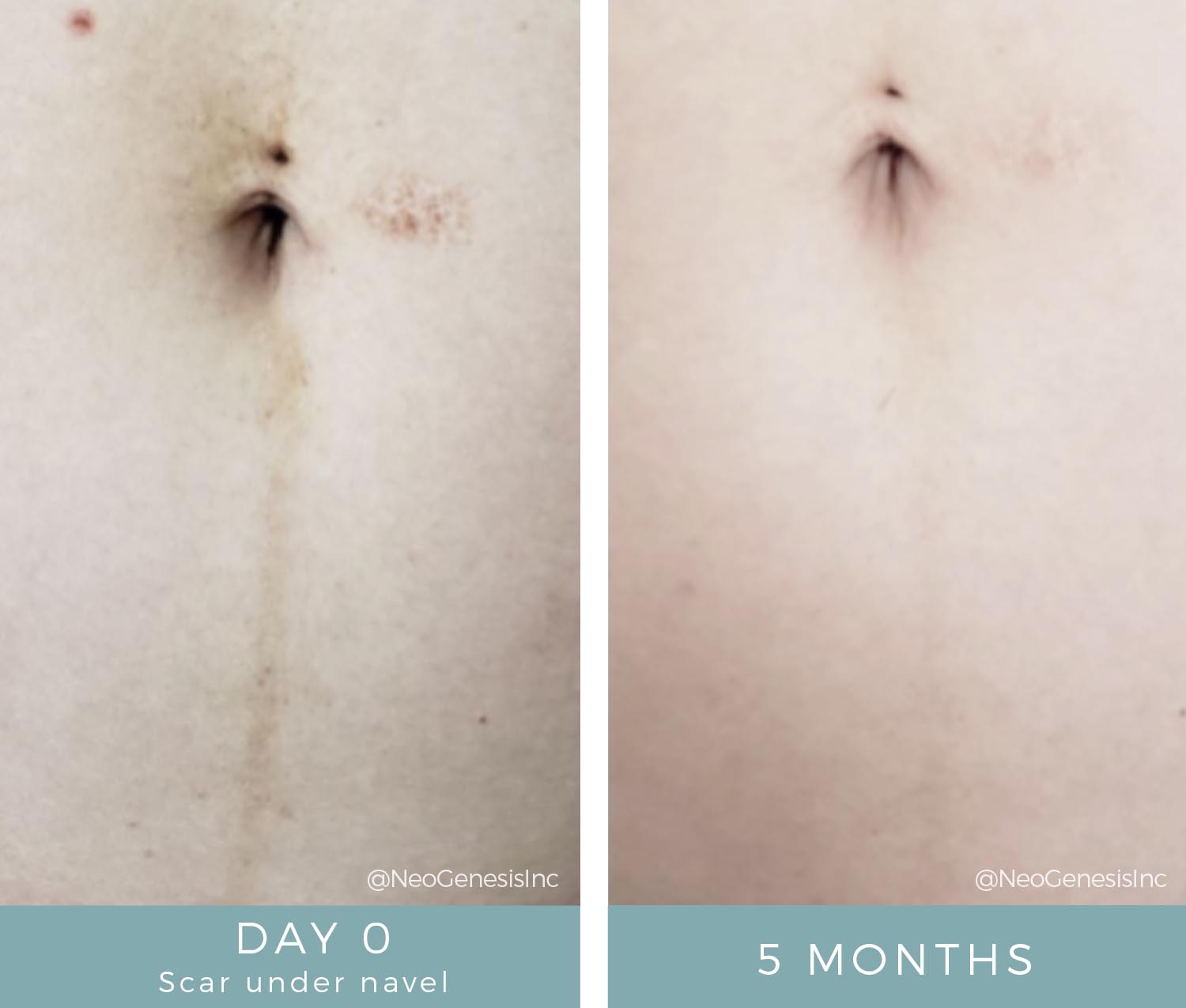 Before + After - Post Pregnancy Scar