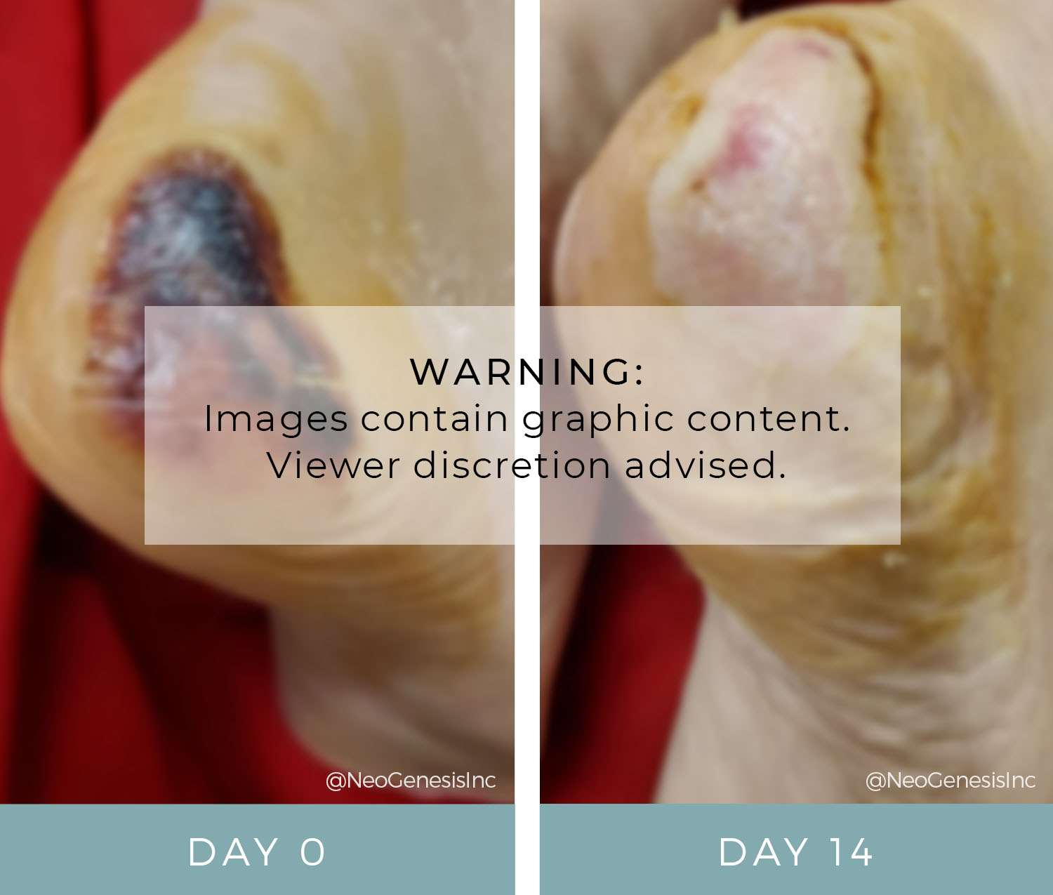 Before + After - Wound Care - Pressure Ulcer