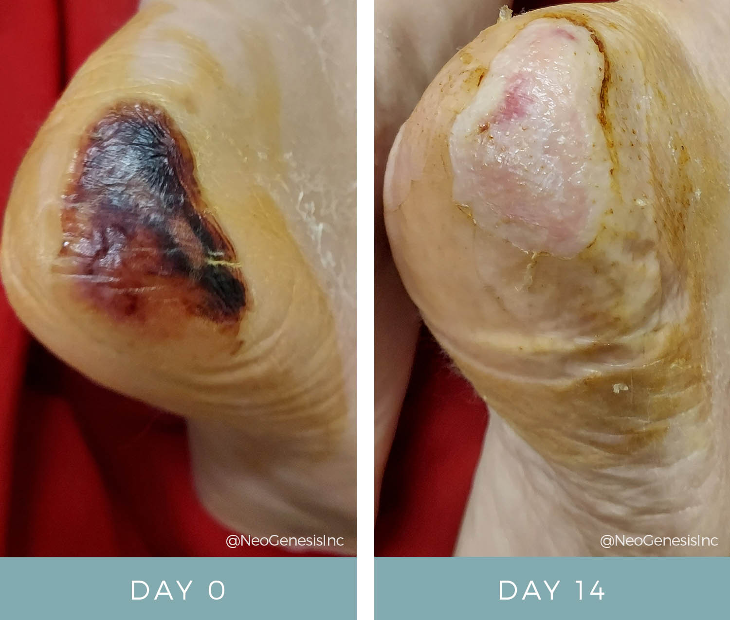 Before + After - Wound Care - Pressure Ulcer