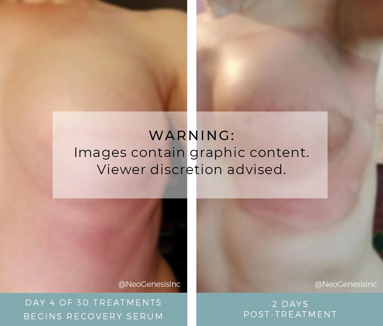 Before + After - Radiation for Breast Cancer