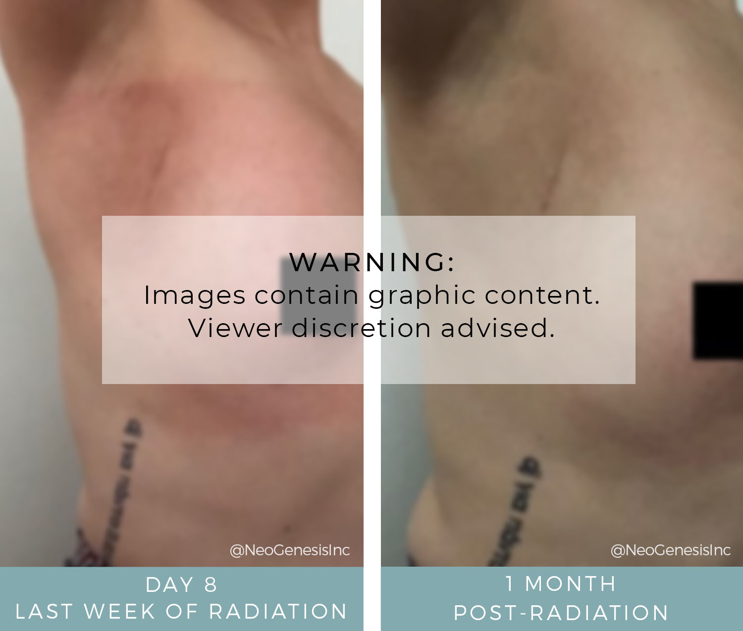 Before + After - Radiation for Breast Cancer