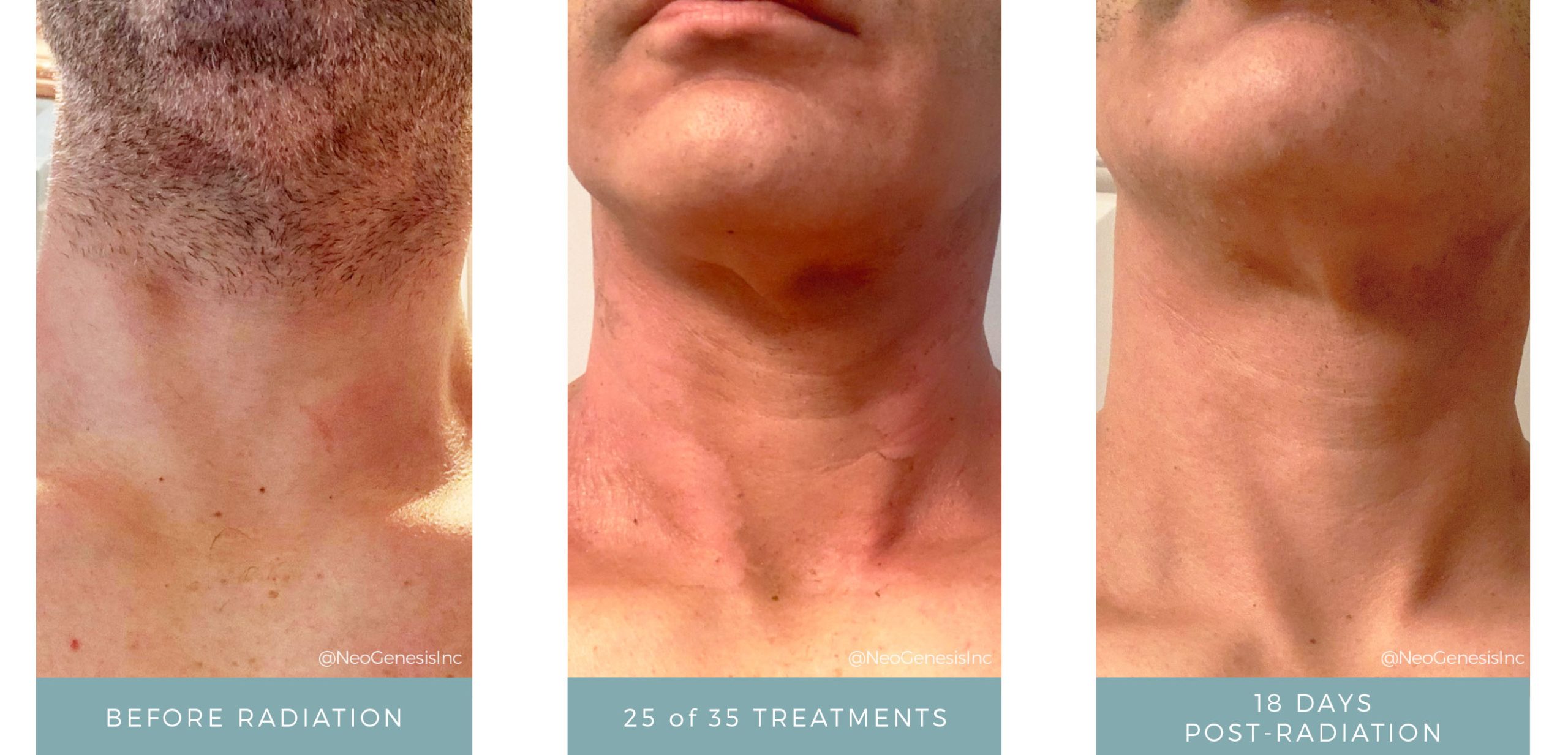Before + After - Radiation for Head + Neck Cancer