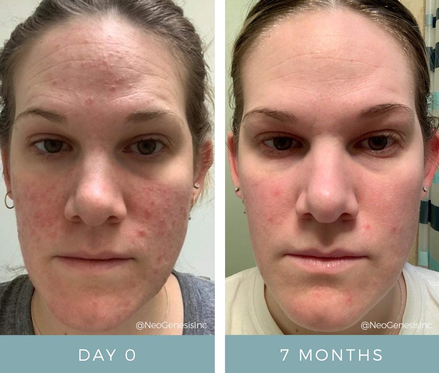 Before + After - Rosacea
