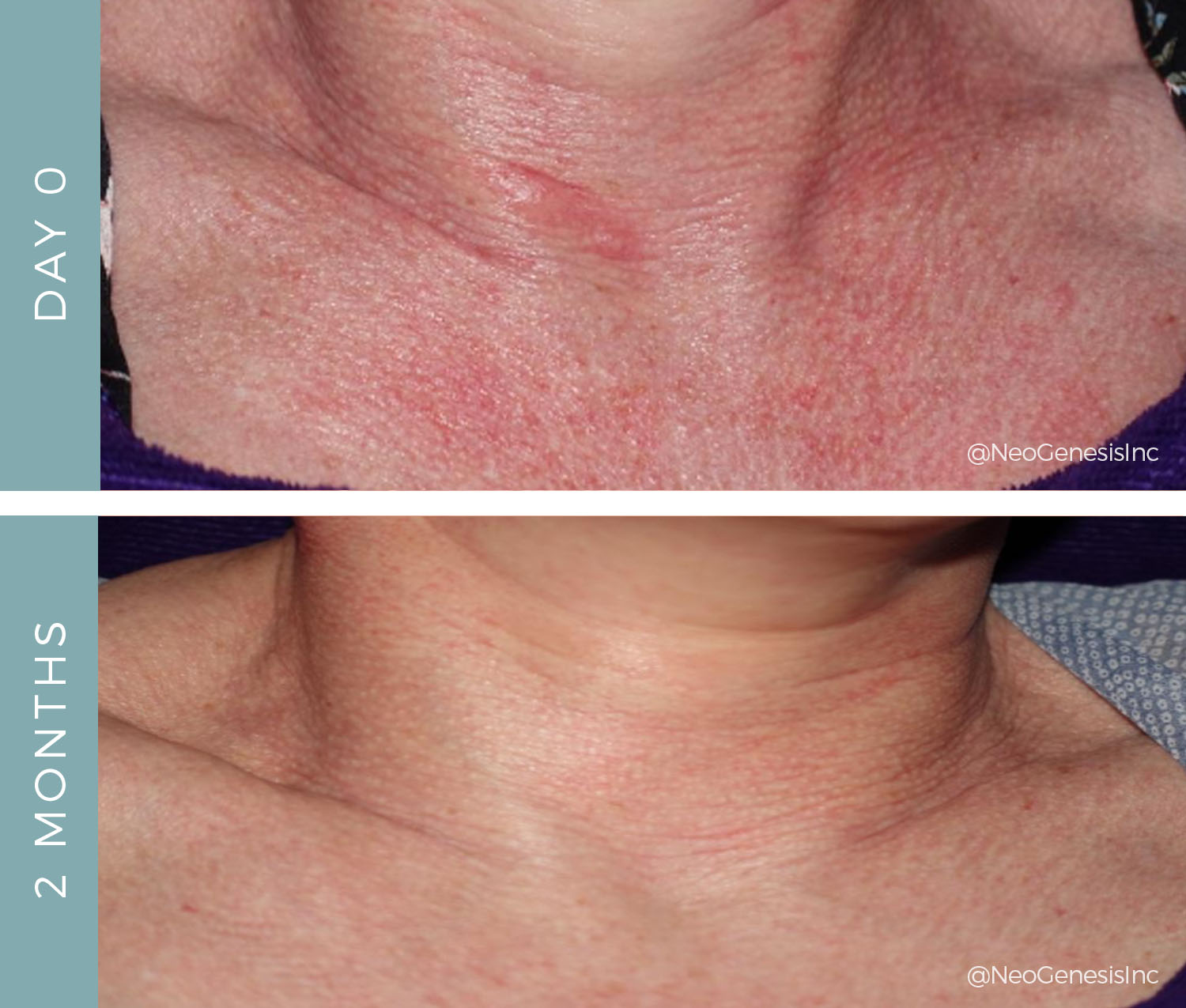 Before + After - Rosacea - Permanent Diffused Redness