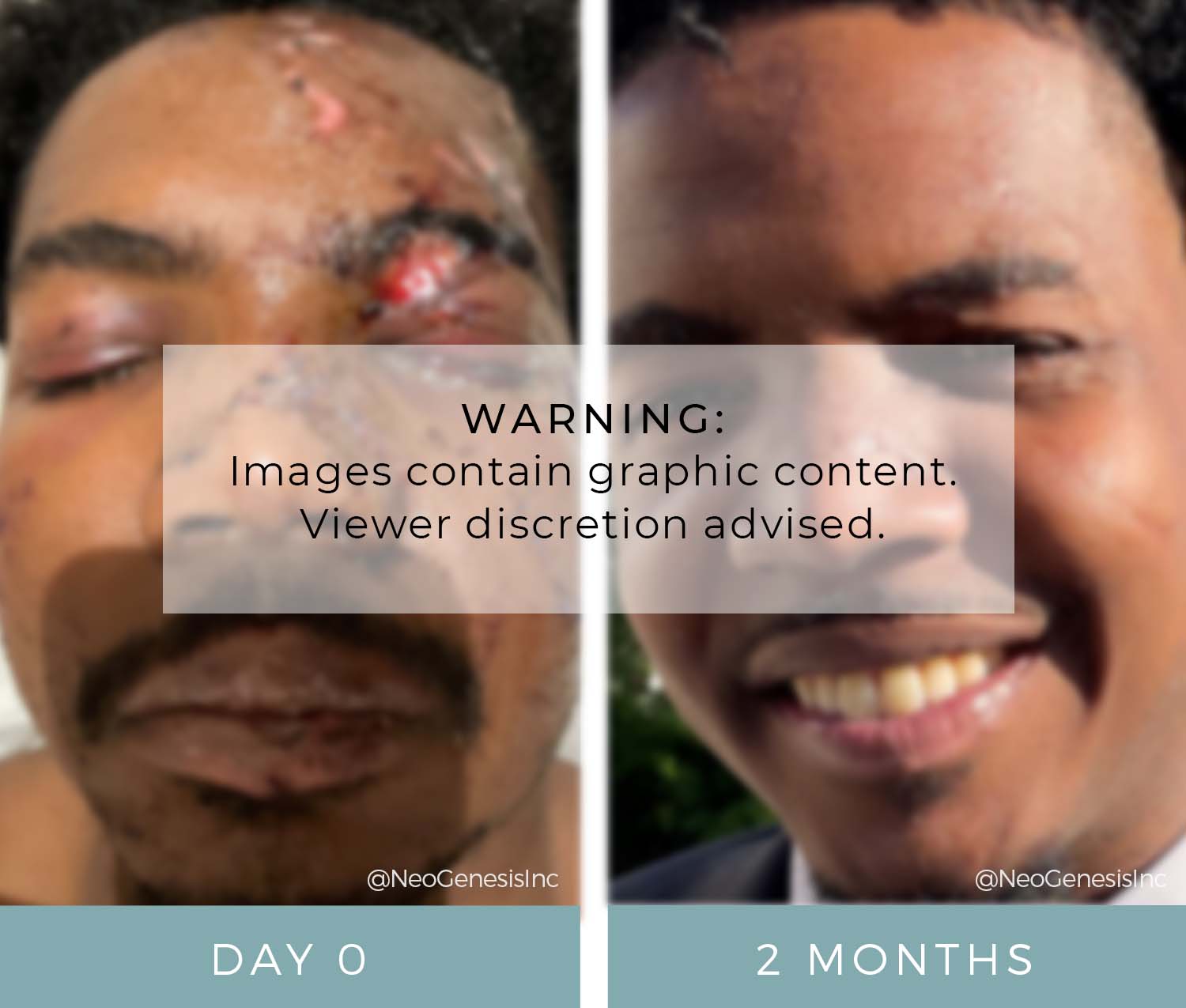 Before + After - Wound Care + Scarring - Car Accident
