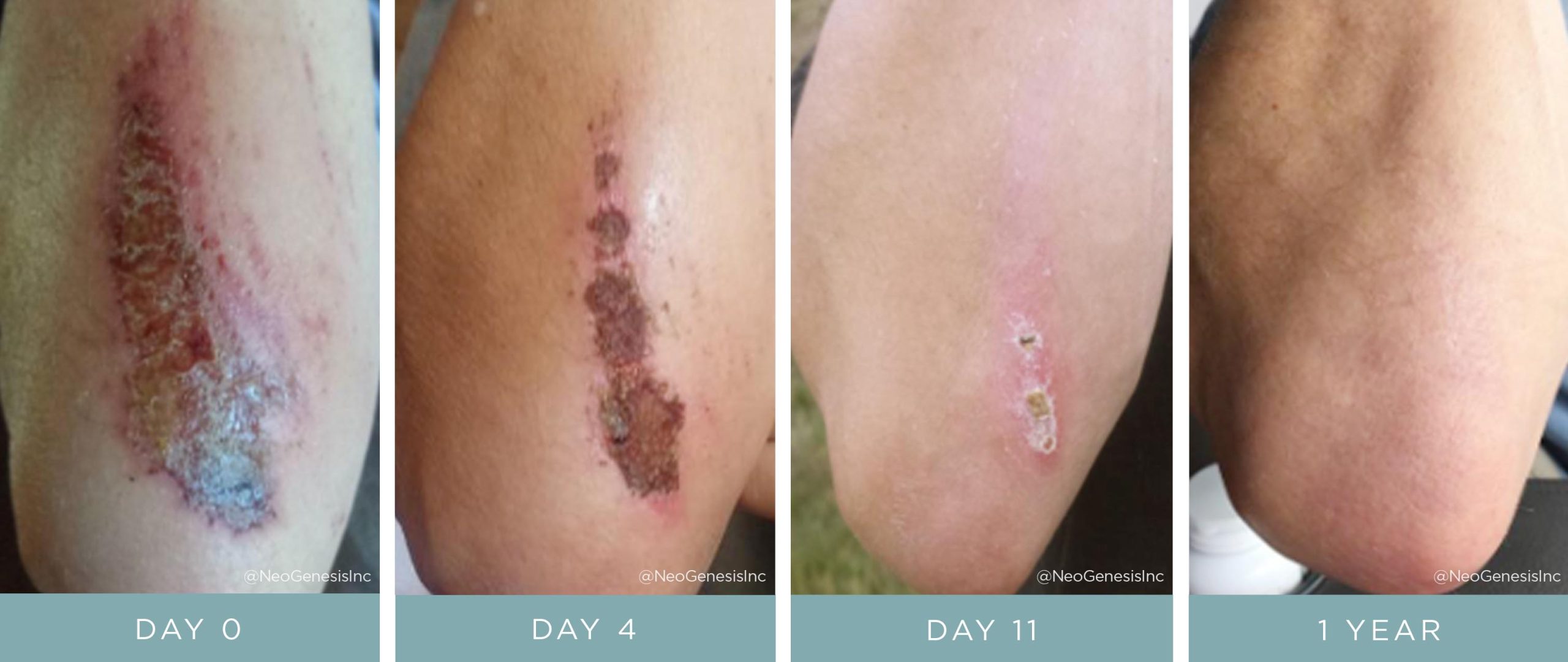 Before + After - Wound Care - Cycling Accident