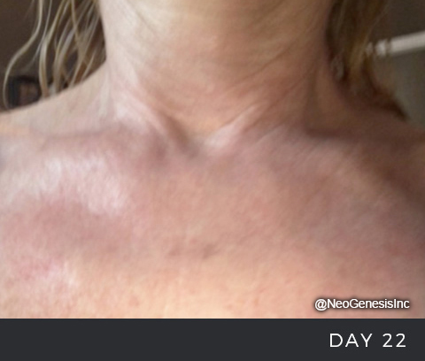 After - Chemical Peel + Radiation Day 22