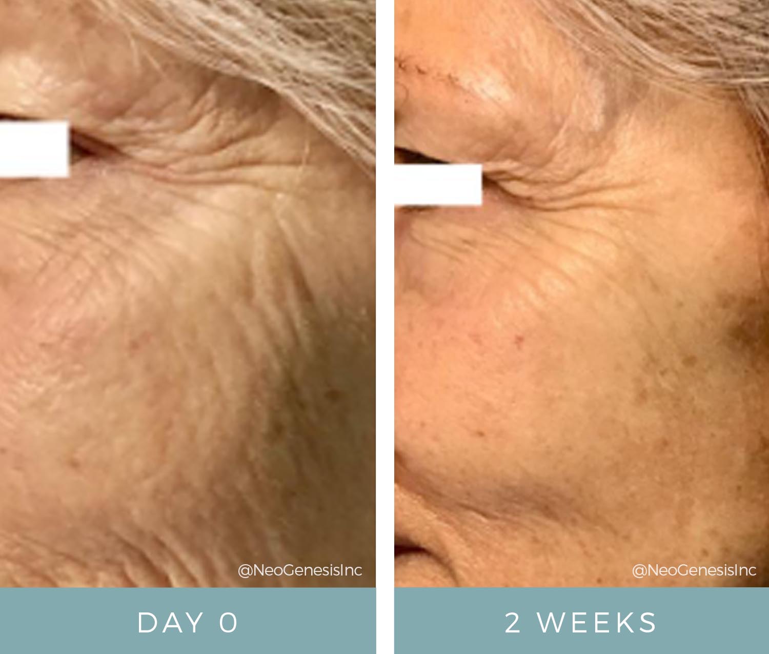 Before + After - Fibroblast